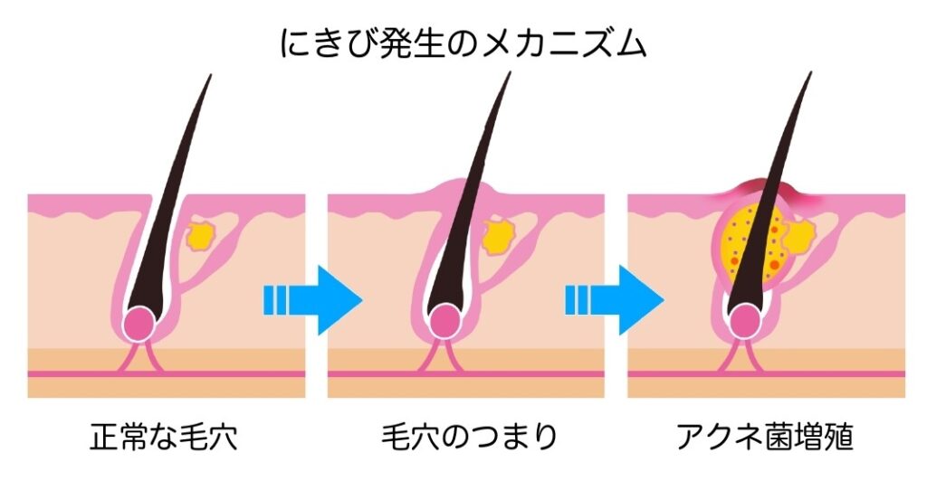 にきび 二色クリニック